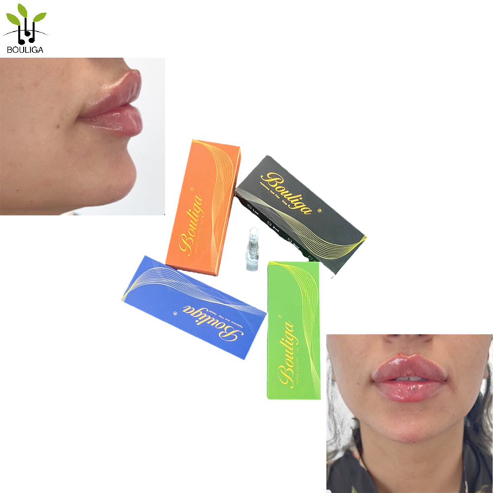 Bouliga Dermal filler 2ml 100% acide hyaluronique concentration 20mg/ml pour Lip Glow Up
